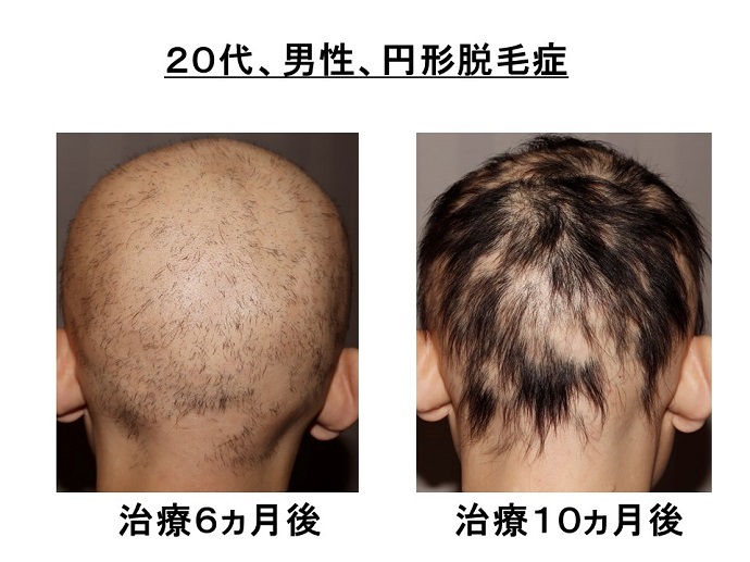 円形脱毛症　病院